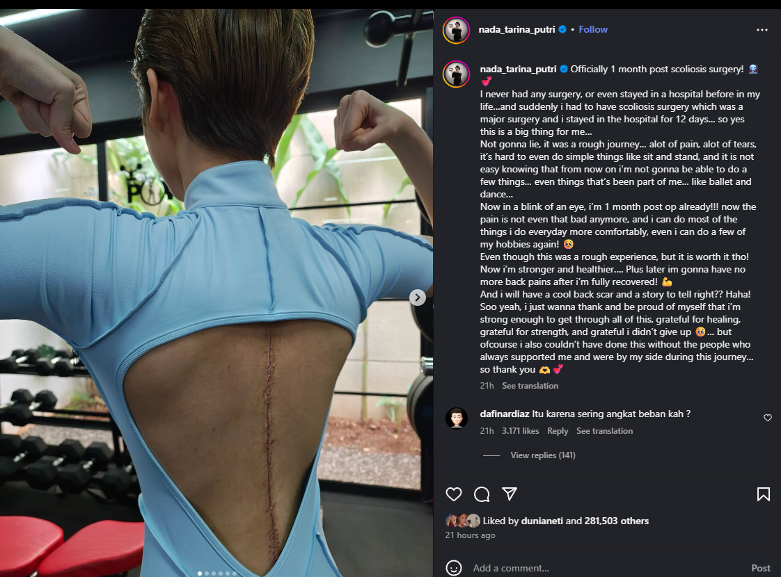 Nada Tarina tunjukkan luka bekas operasinya